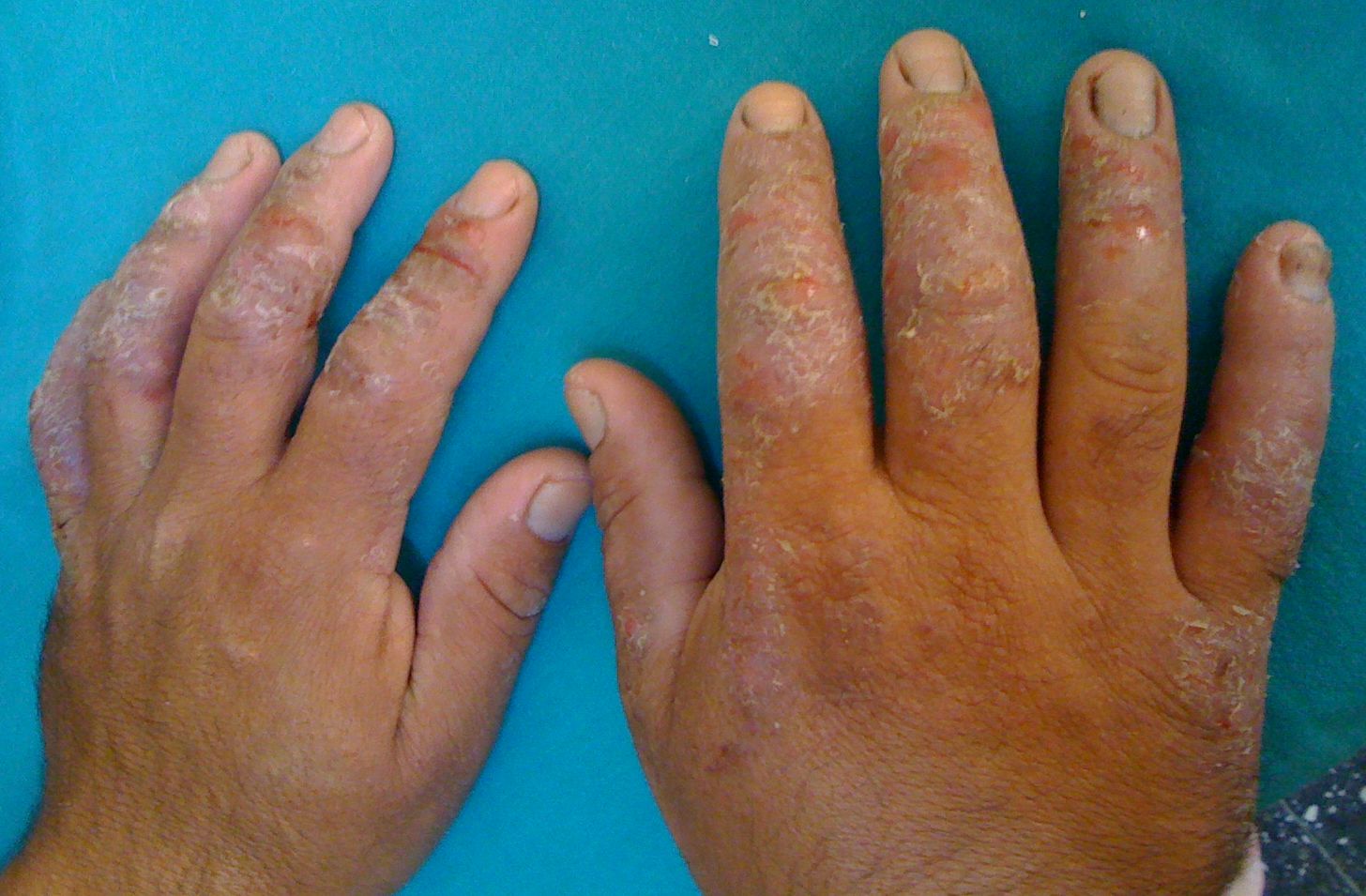 Contact dermatitis | Chemotechnique Diagnostics